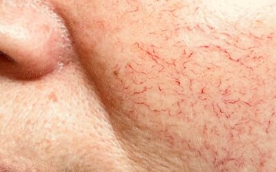 Couperose vaatjes / roodheden / rosacea